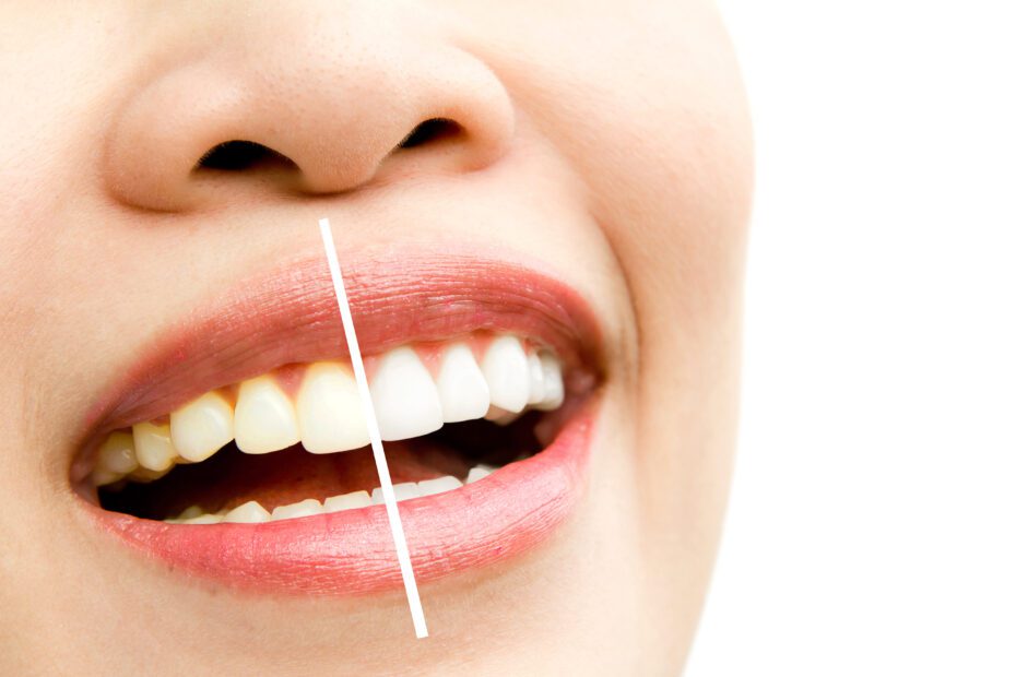 Teeth whitening in Northville | elite smile family dentistry