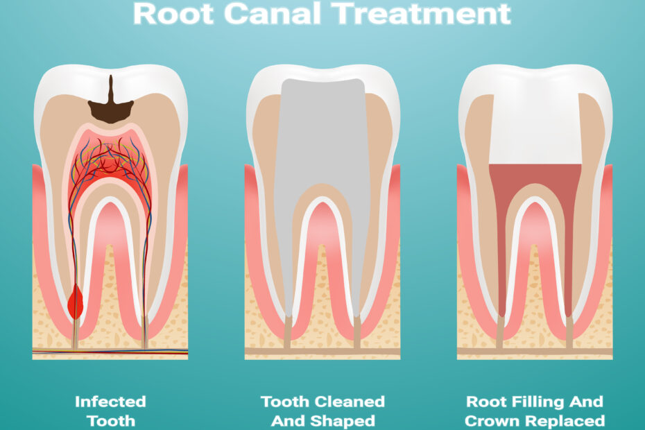 Root Canal Treatment | Elite Smile Family Dentistry