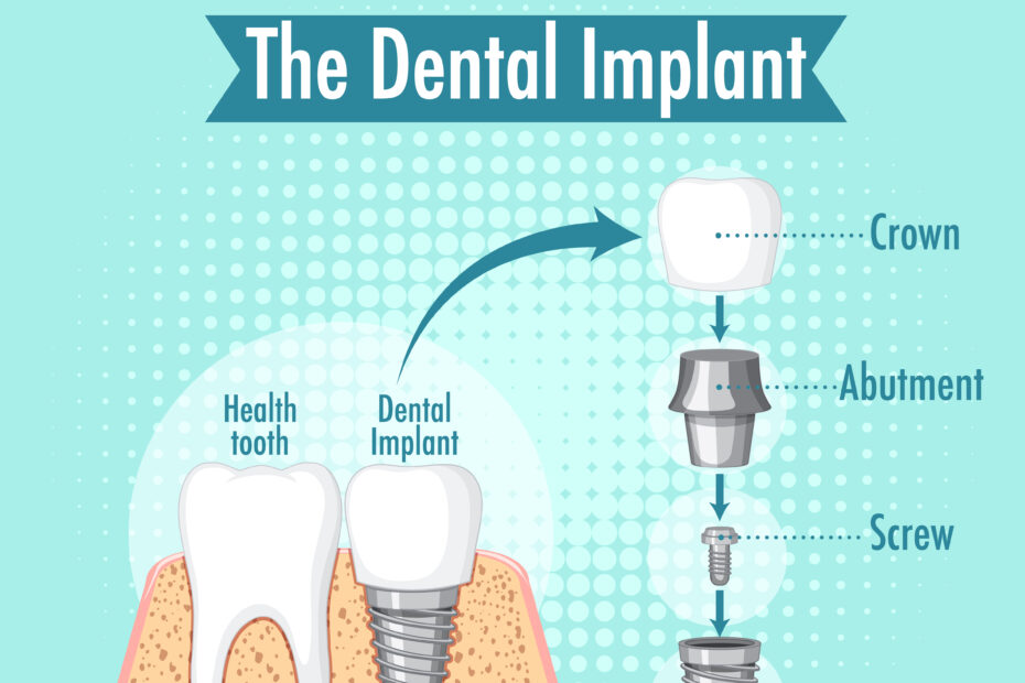 Dental Implant | Elite Smile Family Dentistry