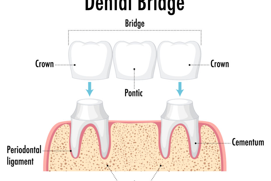 Crown and bridges