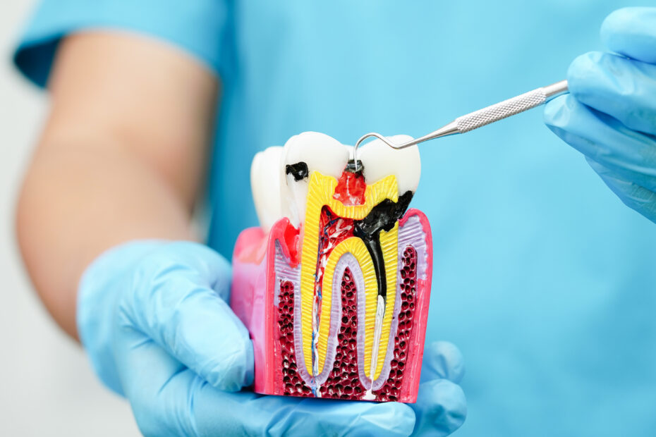 Root Canal Treatment | Elite Smile Family dentistry