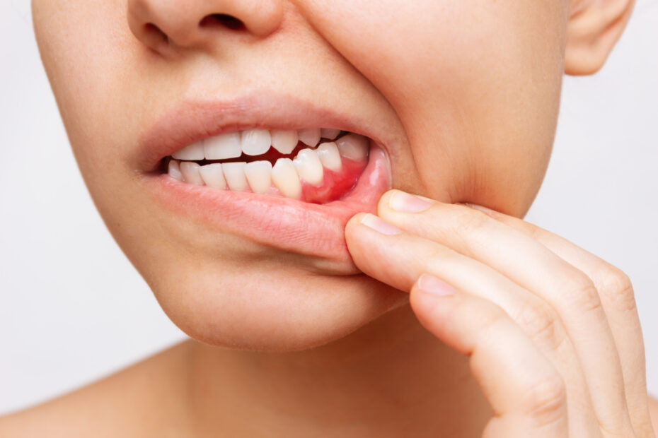 Gum disease treatment | Elite Smile Family Dentistry