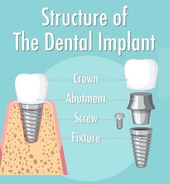 Implant Dentistry | Elite smile family dental