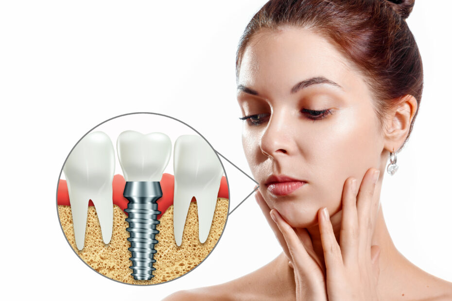 Dental implants