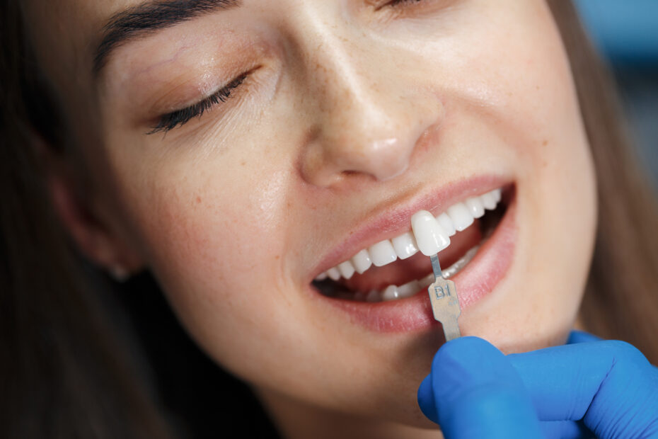 porclain veneers