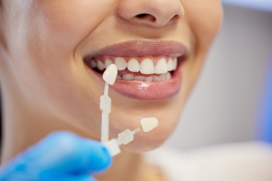 porclain veneers