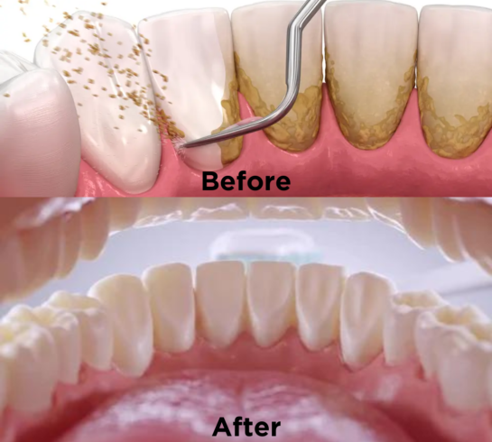 Before After | Elite Smile Family dentistry | Tooth cleaning