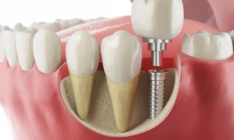 Dental Implan in northville