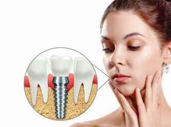 Dental implants