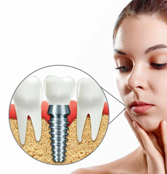 Dental implants