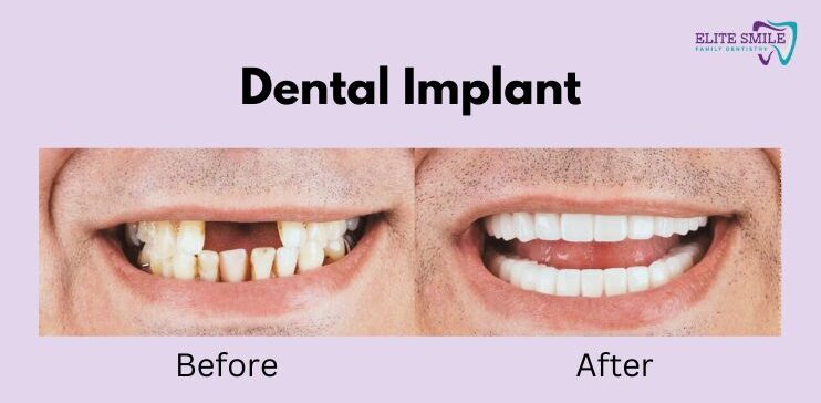 Dental implant before after excellence