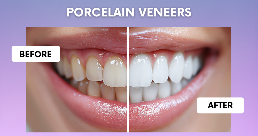 Porcelain Veneers | Elite Smile Family dentistry