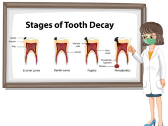Root canal treatment