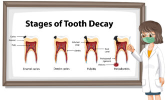 Root canal treatment