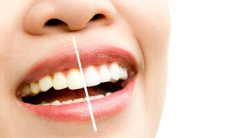 Teeth whitening in Northville | elite smile family dentistry