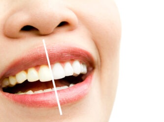 Teeth whitening in Northville | elite smile family dentistry