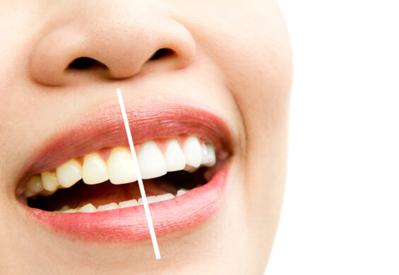 Teeth whitening in Northville | elite smile family dentistry