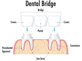 Crown and bridges