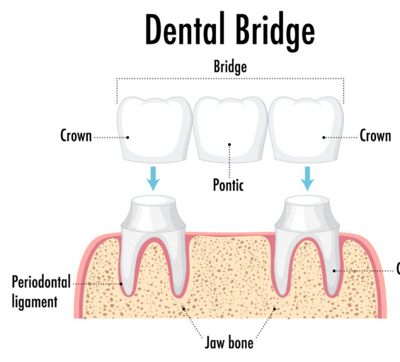 Crown and bridges