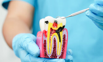 Root Canal Treatment | Elite Smile Family dentistry