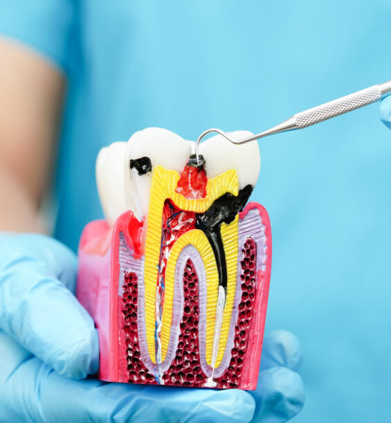 Root Canal Treatment | Elite Smile Family dentistry