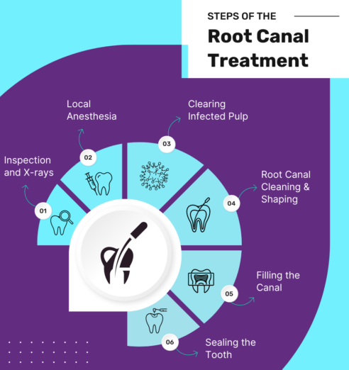 Root Canal Treatment Blog | Elite Smile Family Dentistry