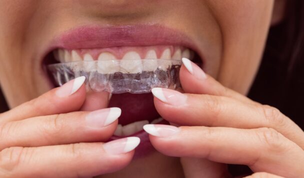 Clear aligners | Elite Smile Family Dentistry