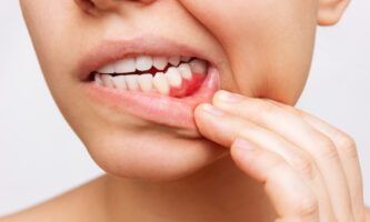 Gum disease treatment | Elite Smile Family Dentistry