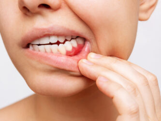 Gum disease treatment | Elite Smile Family Dentistry