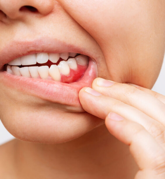 Gum disease treatment | Elite Smile Family Dentistry