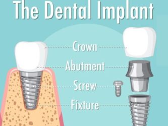 Implant Dentistry | Elite smile family dental