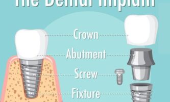 Implant Dentistry | Elite smile family dental