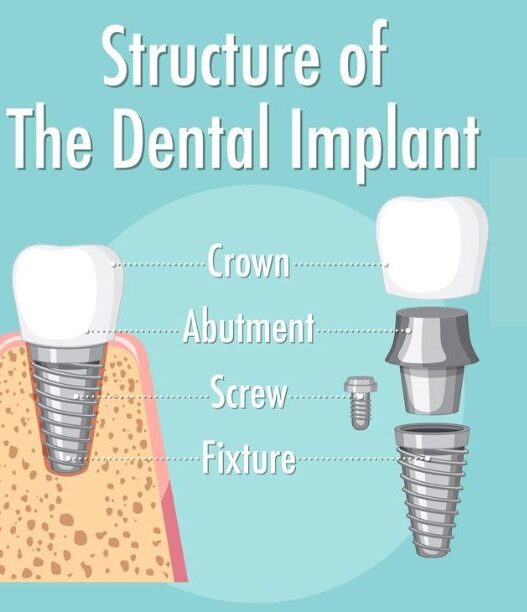 Implant Dentistry | Elite smile family dental