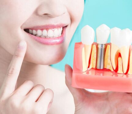 Implant dentistry | Elite Smile Family Dentistry