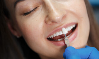 Porclain Veneers