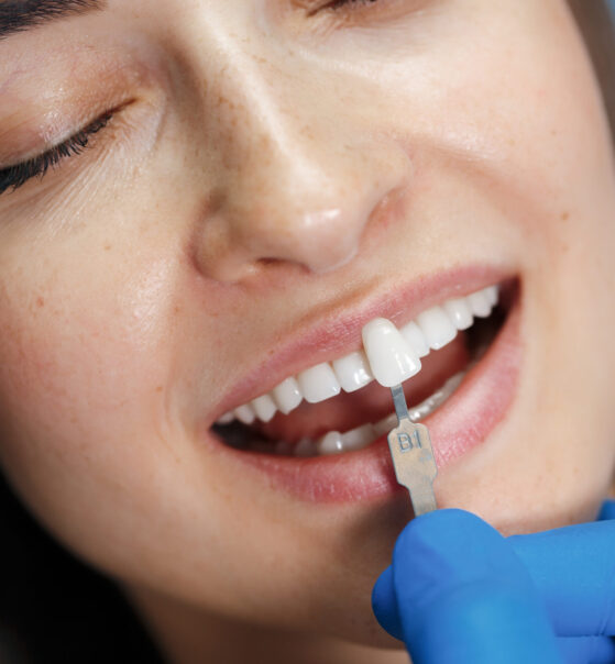 porclain veneers