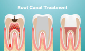 Root Canal Treatment | Elite Smile Family Dentistry