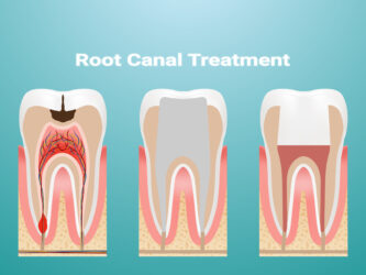 Root Canal Treatment | Elite Smile Family Dentistry