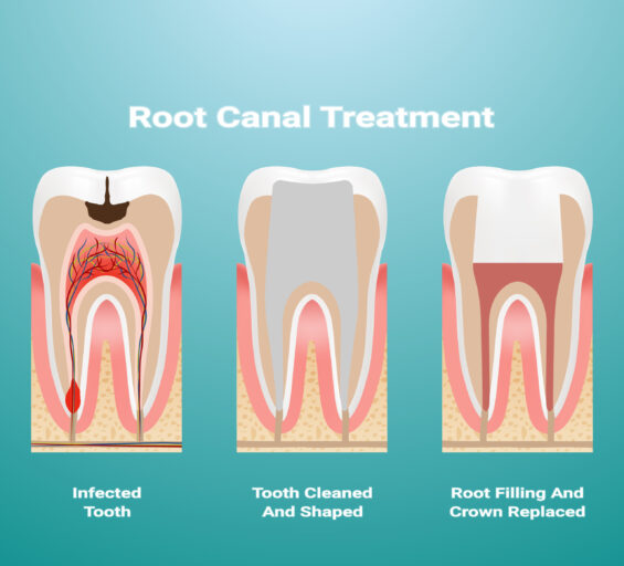 Root Canal Treatment | Elite Smile Family Dentistry