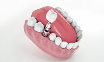 Implant dentistry | Elite Smile Family Dentistry