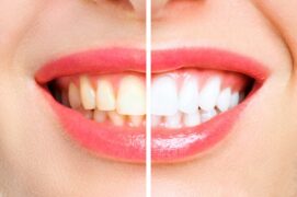 Teeth whitening Northville | Elite Smile Family Dentistry