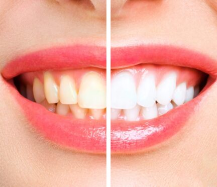 Teeth whitening Northville | Elite Smile Family Dentistry