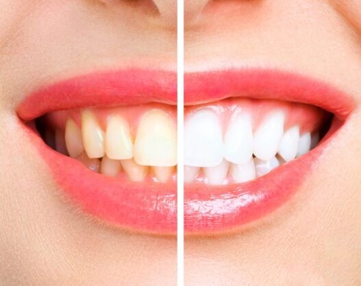 Teeth whitening Northville | Elite Smile Family Dentistry