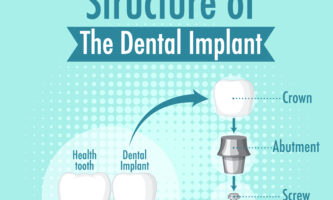 Dental Implant | Elite Smile Family Dentistry