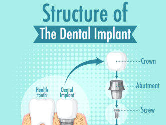 Dental Implant | Elite Smile Family Dentistry