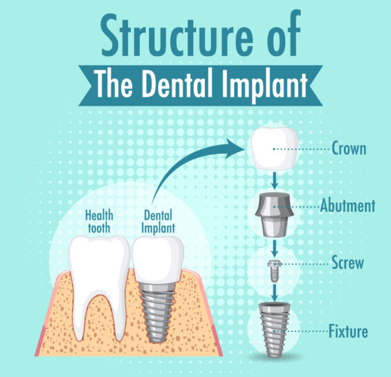 Dental Implant | Elite Smile Family Dentistry